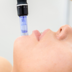 Microneedling