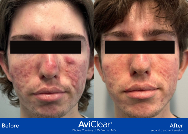 AviClear Before and After Template 2 images