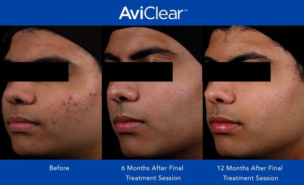 AviClear Before and After 12 month 4