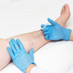 Sclerotherapy - Spider Vein Treatment