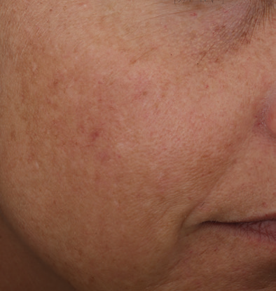 even correct serum 1 baseline 