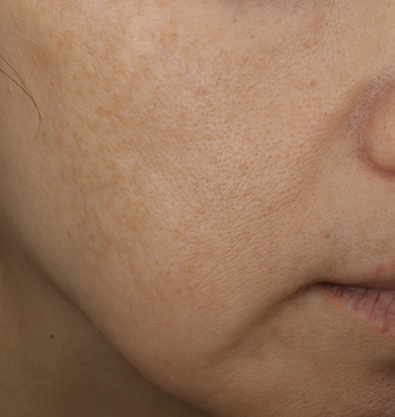even correct serum 2 week 12