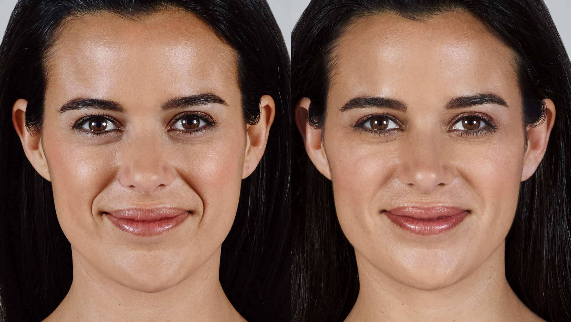 1 ml cheek filler before and after